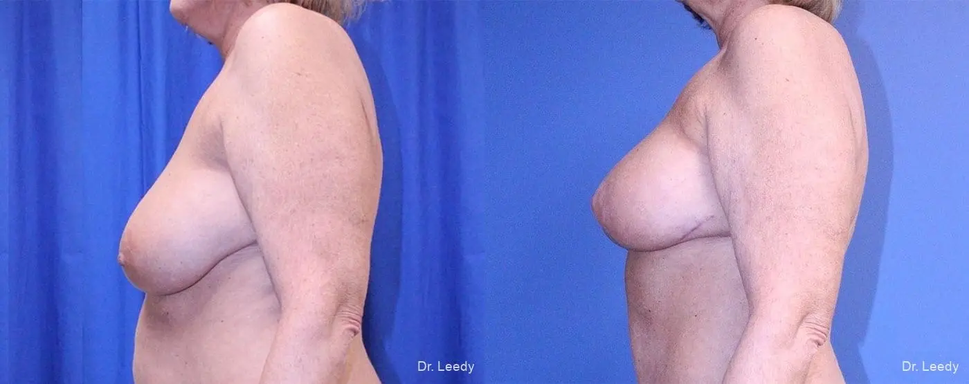 Breast Lift And Augmentation: Patient 4 - Before and After 5