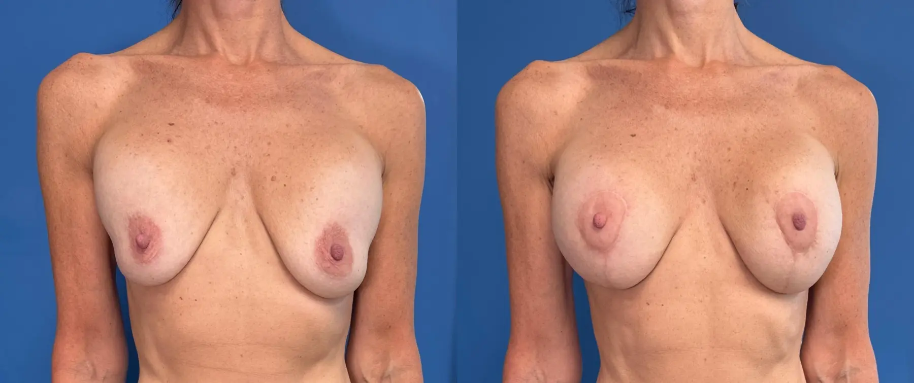 Breast Lift And Augmentation: Patient 8 - Before and After  