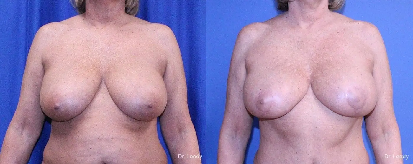 Breast Lift And Augmentation: Patient 2 - Before and After  