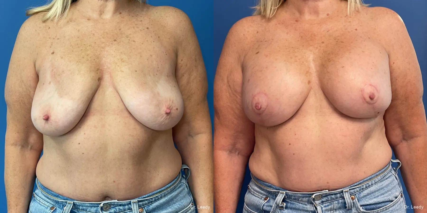 Breast Lift And Augmentation: Patient 5 - Before and After  
