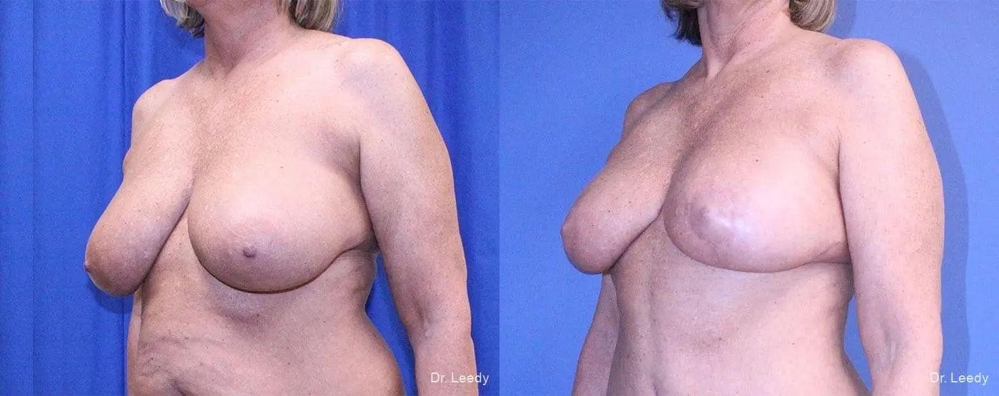 Breast Lift And Augmentation: Patient 4 - Before and After 4