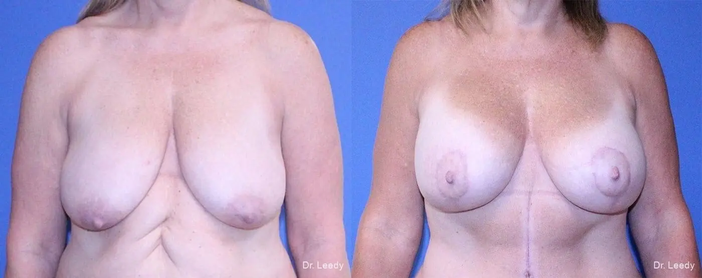 Breast Lift And Augmentation: Patient 3 - Before and After  