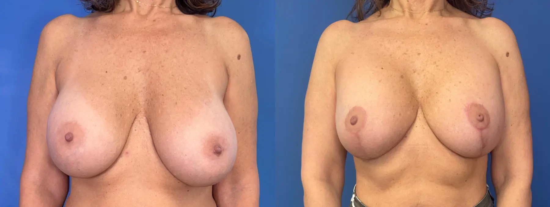 Breast Lift And Augmentation: Patient 6 - Before and After  