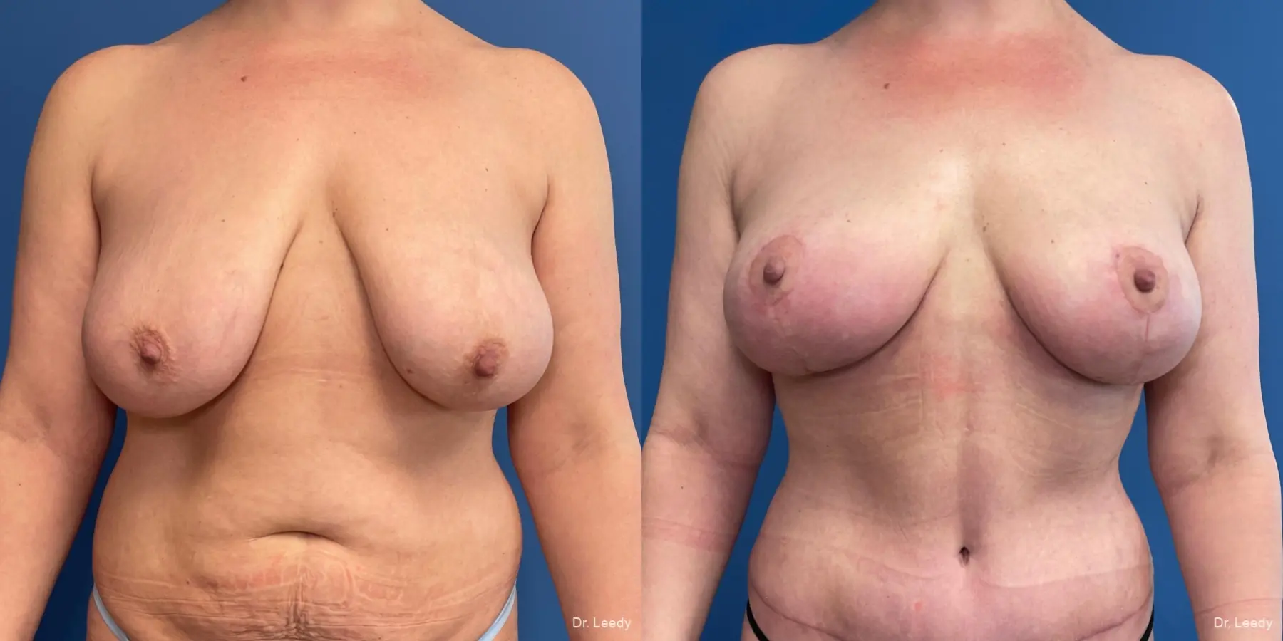 Breast Lift: Patient 1 - Before and After  