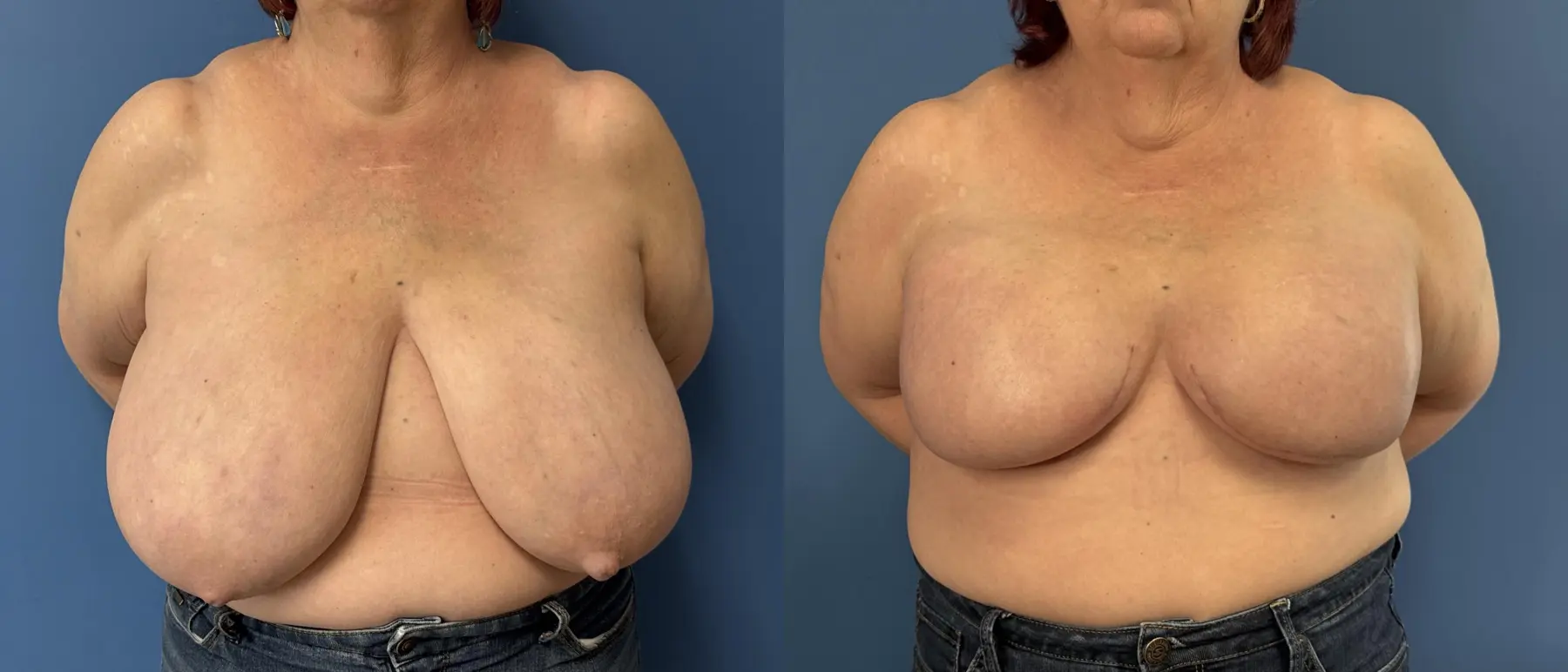 Breast Reconstruction: Patient 2 - Before and After  