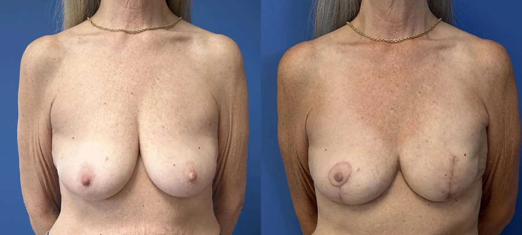 Breast Reconstruction: Patient 1 - Before and After  