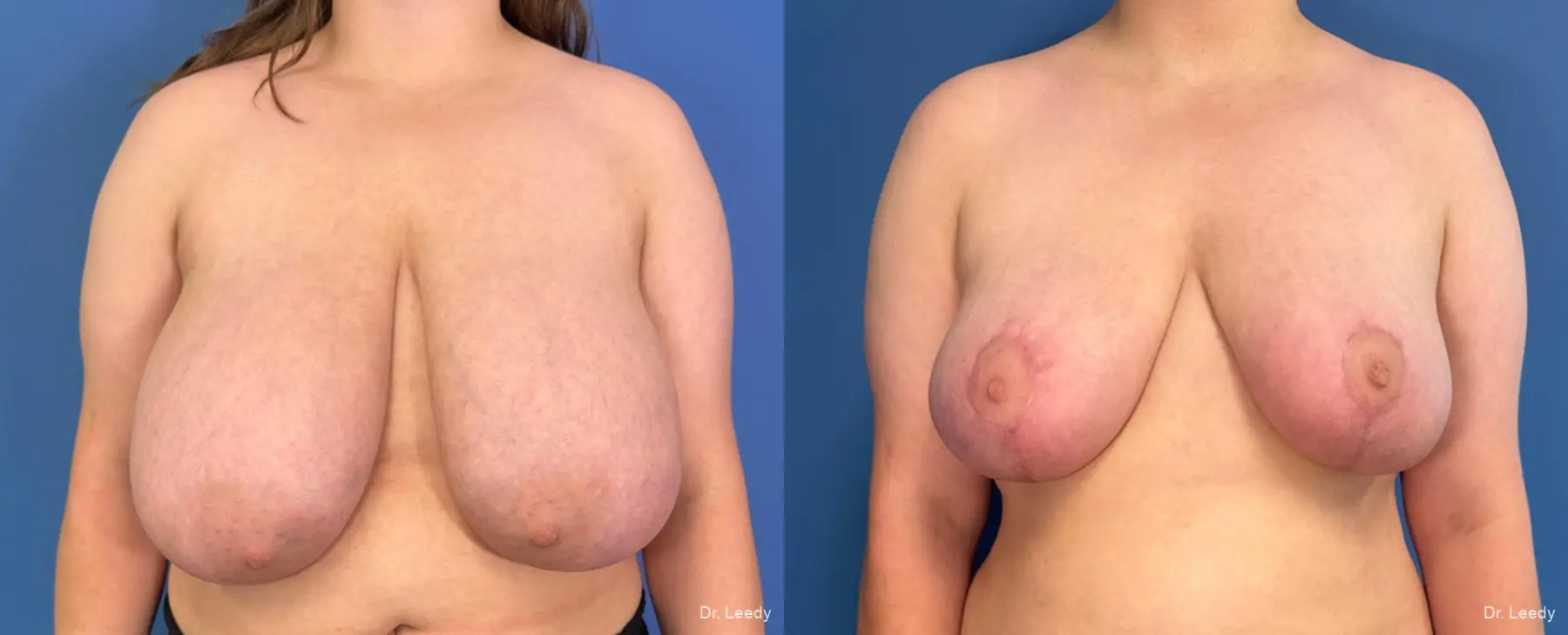 Breast Reduction: Patient 4 - Before and After  
