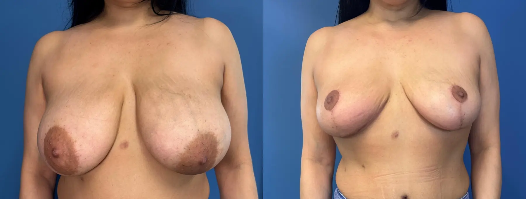 Breast Reduction: Patient 7 - Before and After  