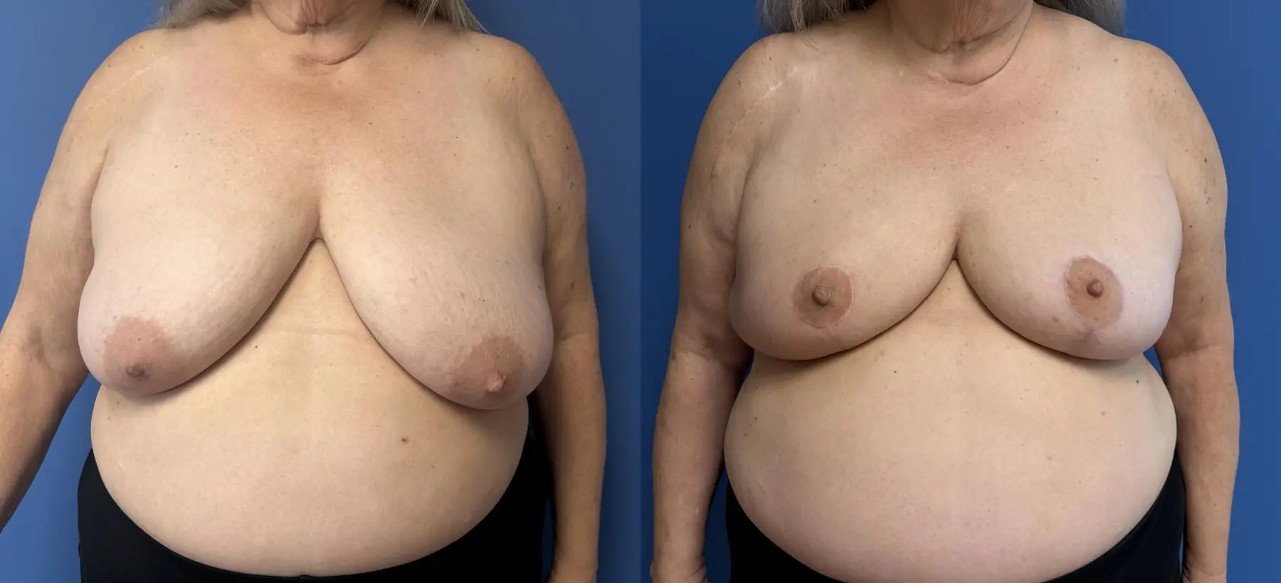 Breast Reduction: Patient 8 - Before and After  