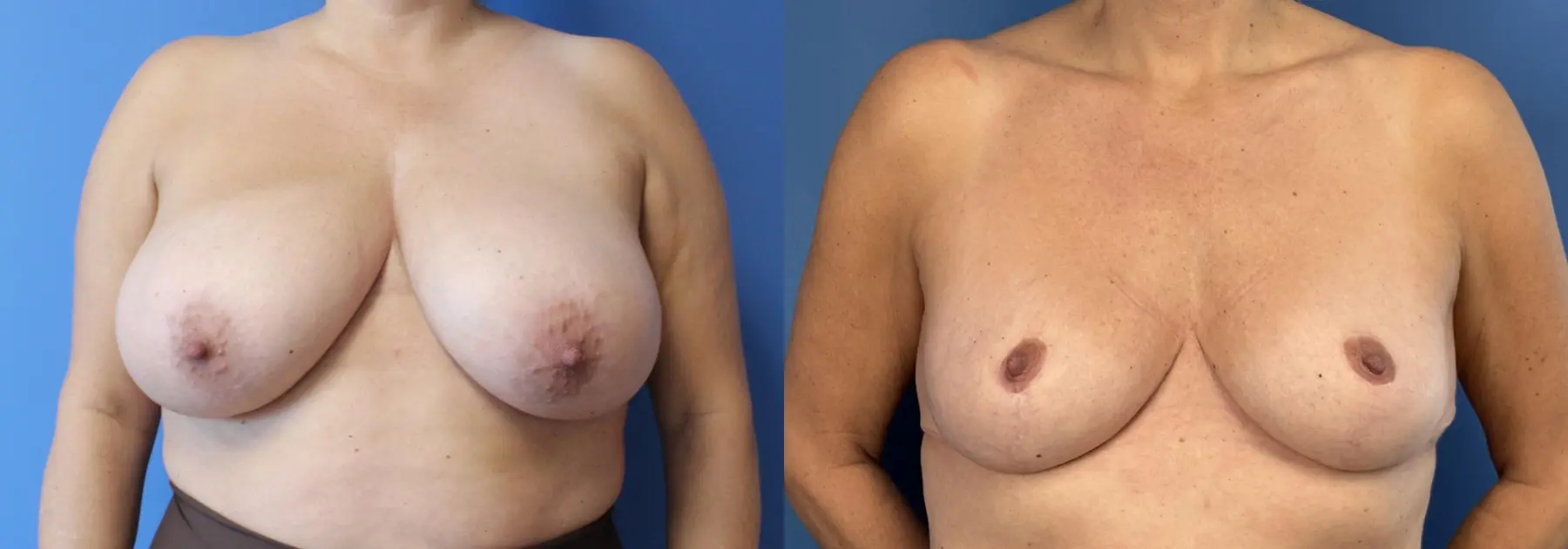 Breast Reduction: Patient 6 - Before and After  