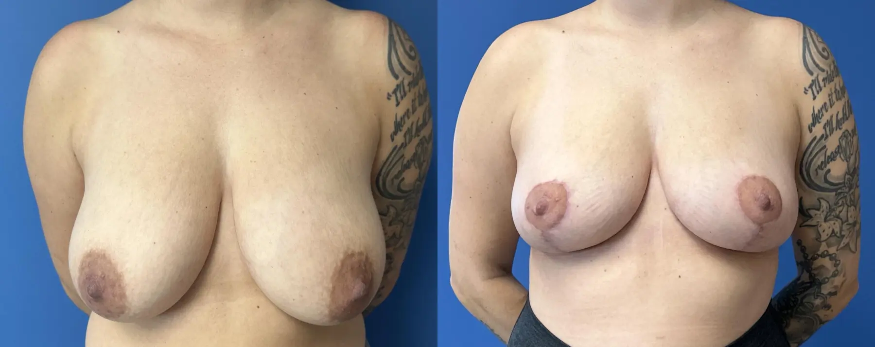 Breast Reduction: Patient 3 - Before and After  