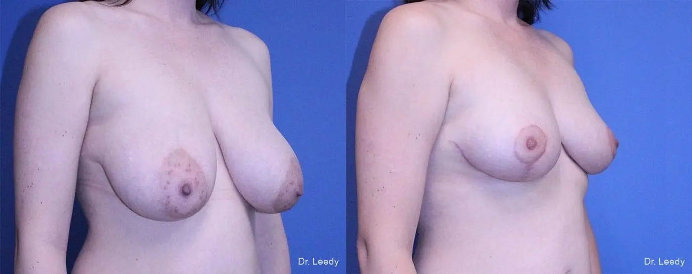 Breast Reduction: Patient 2 - Before and After 2