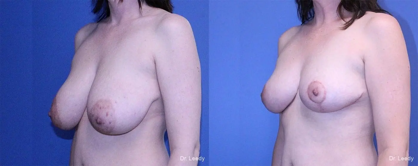 Breast Reduction: Patient 1 - Before and After 4