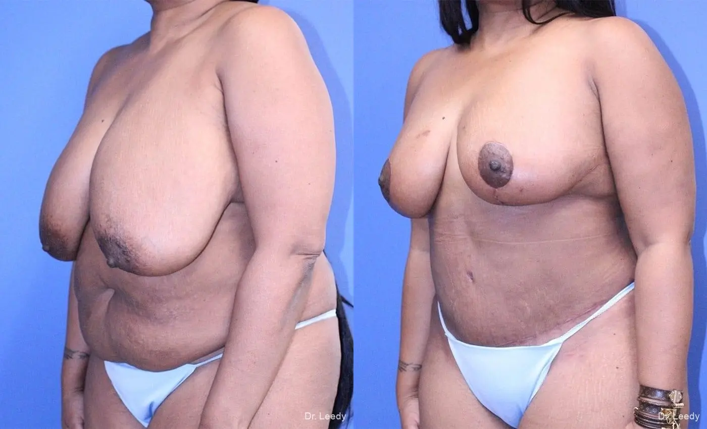 Breast Reduction: Patient 1 - Before and After 5