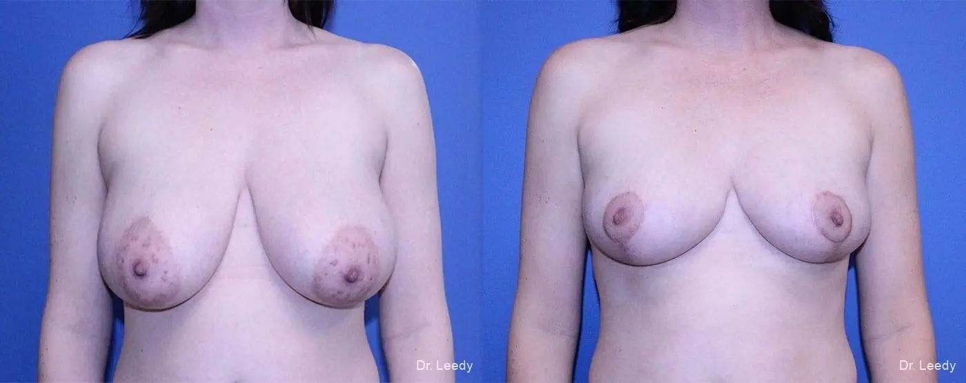 Breast Reduction: Patient 1 - Before and After  