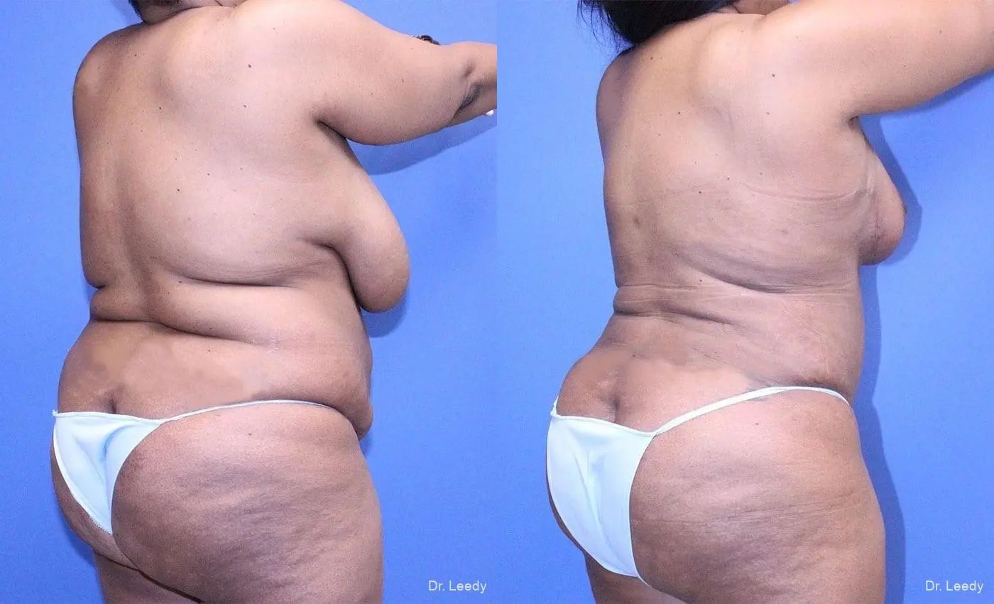 Breast Reduction: Patient 2 - Before and After 4