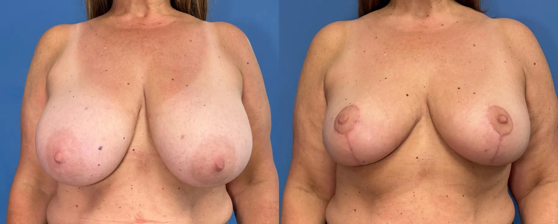 Breast Reduction: Patient 5 - Before and After  