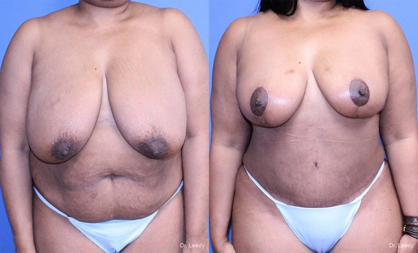 Breast Reduction: Patient 2 - Before and After  