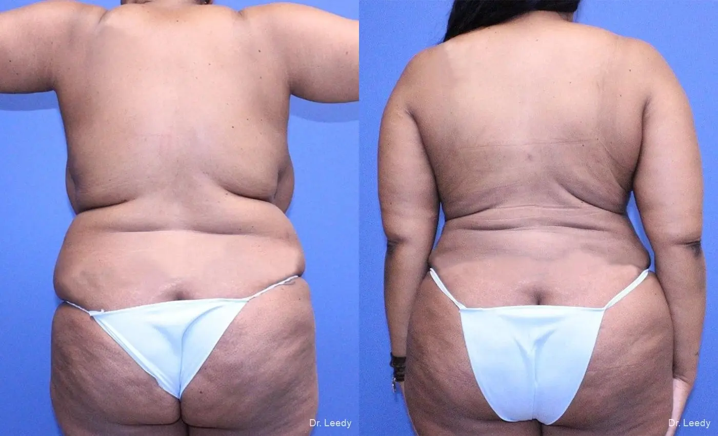 Breast Reduction: Patient 1 - Before and After 7