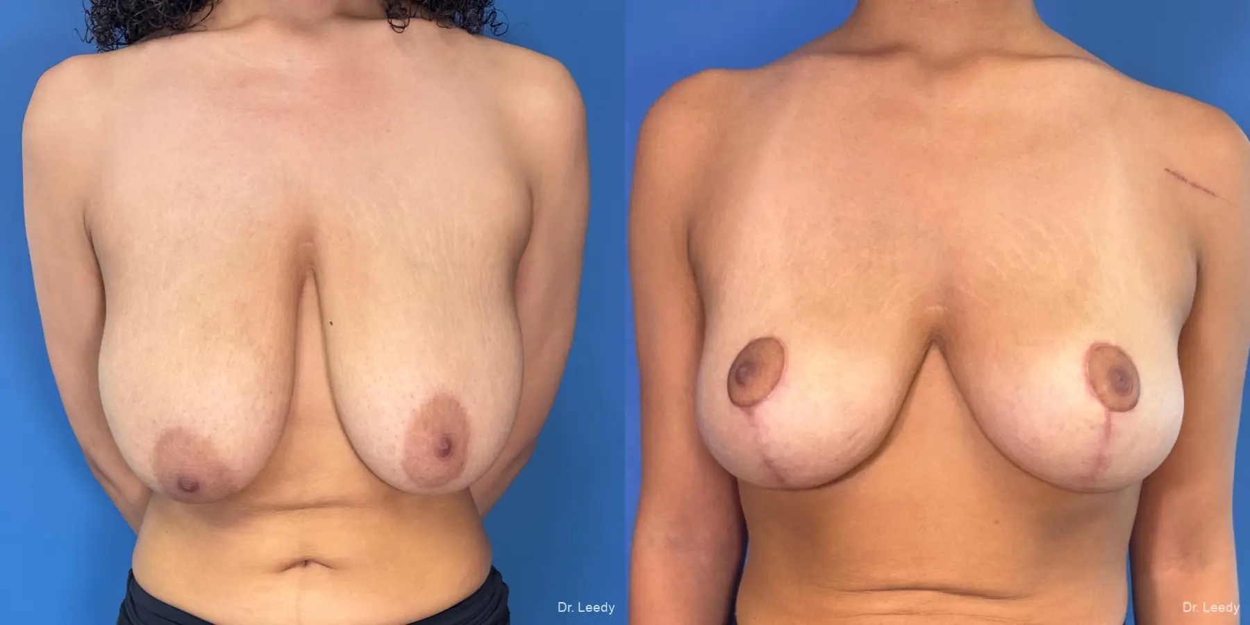 Breast Reduction: Patient 5 - Before and After  