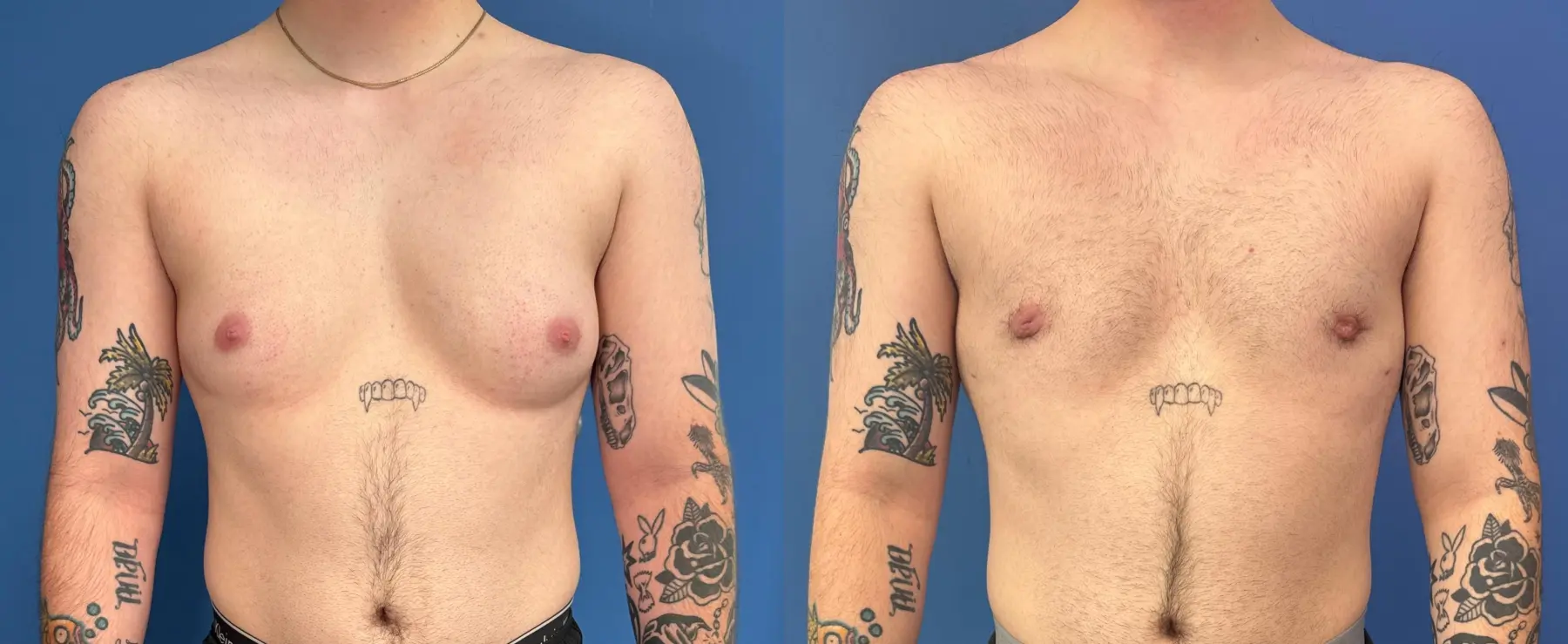 Breast-reduction-for-men: Patient 1 - Before and After  