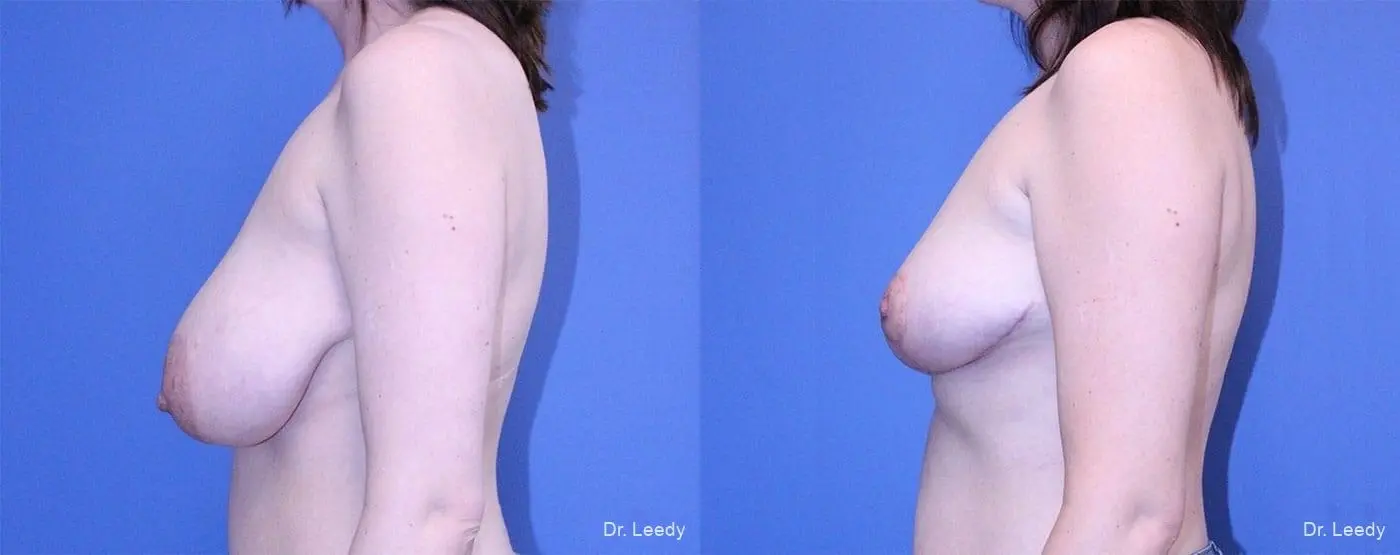 Breast Reduction: Patient 1 - Before and After 5