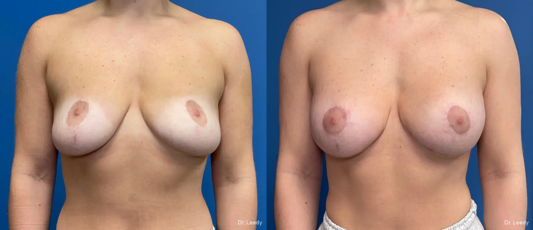 Breast Revision: Patient 1 - Before and After  