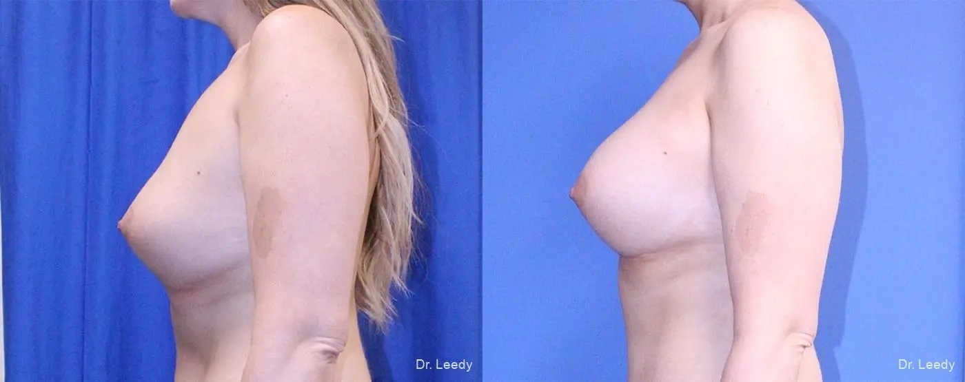 Breast Revision: Patient 2 - Before and After 5