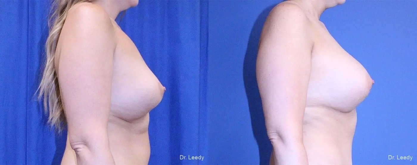 Breast Revision: Patient 2 - Before and After 3
