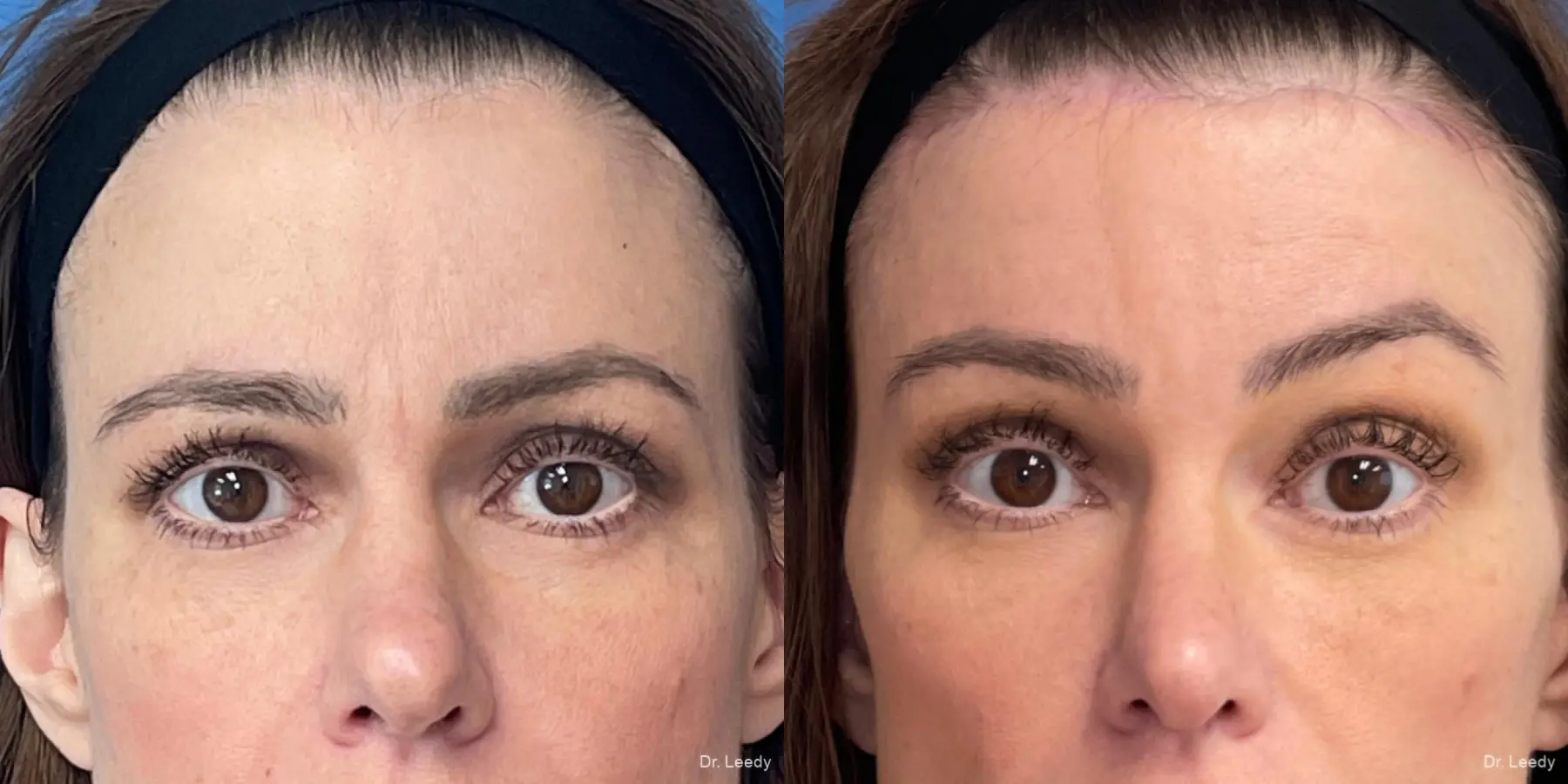 Brow Lift: Patient 1 - Before and After 2
