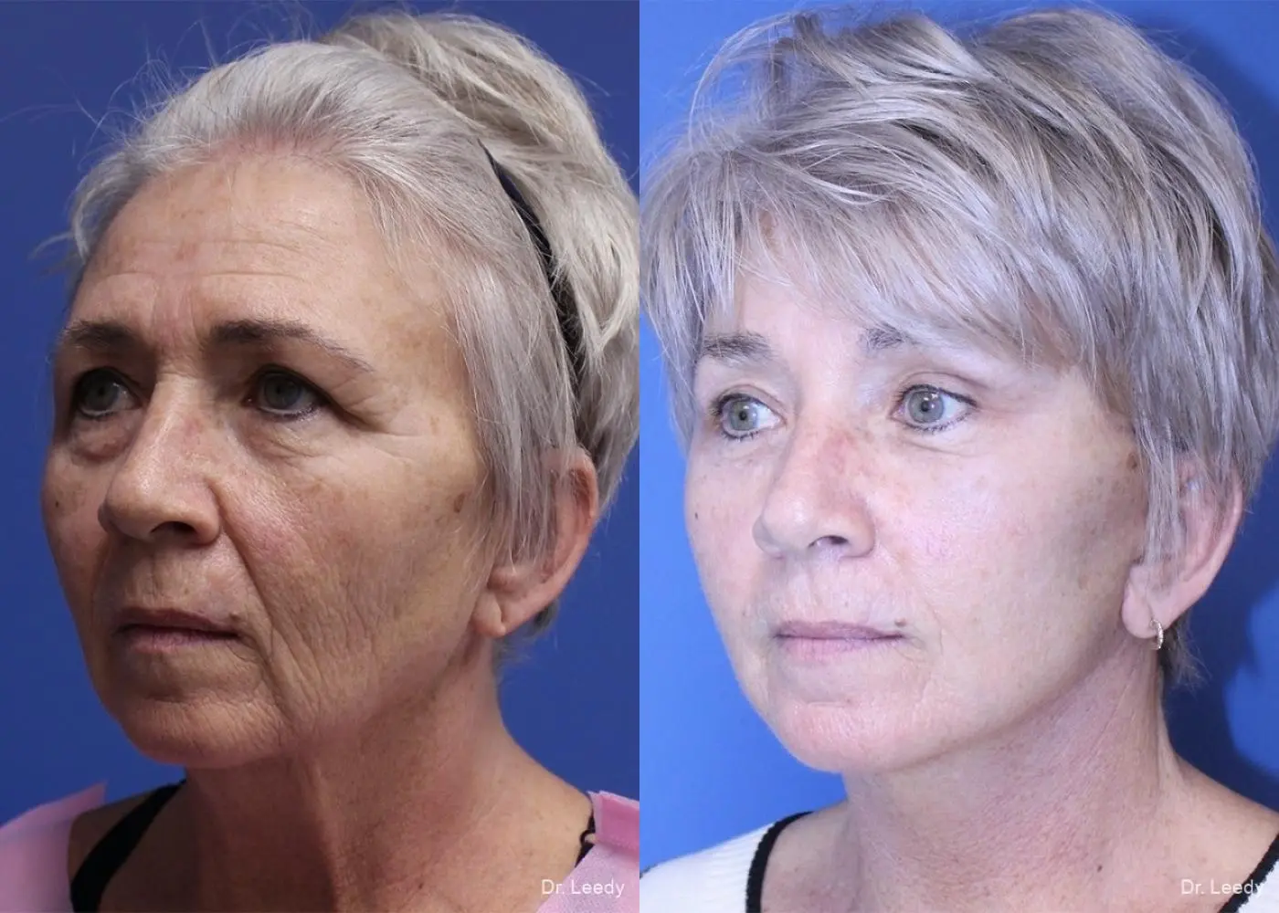 Brow Lift: Patient 3 - Before and After 4