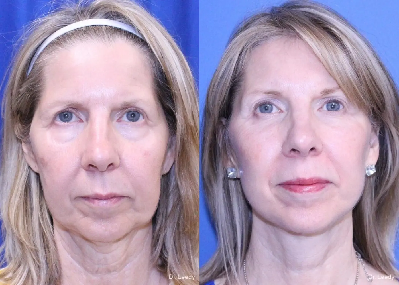 Brow Lift: Patient 4 - Before and After 1