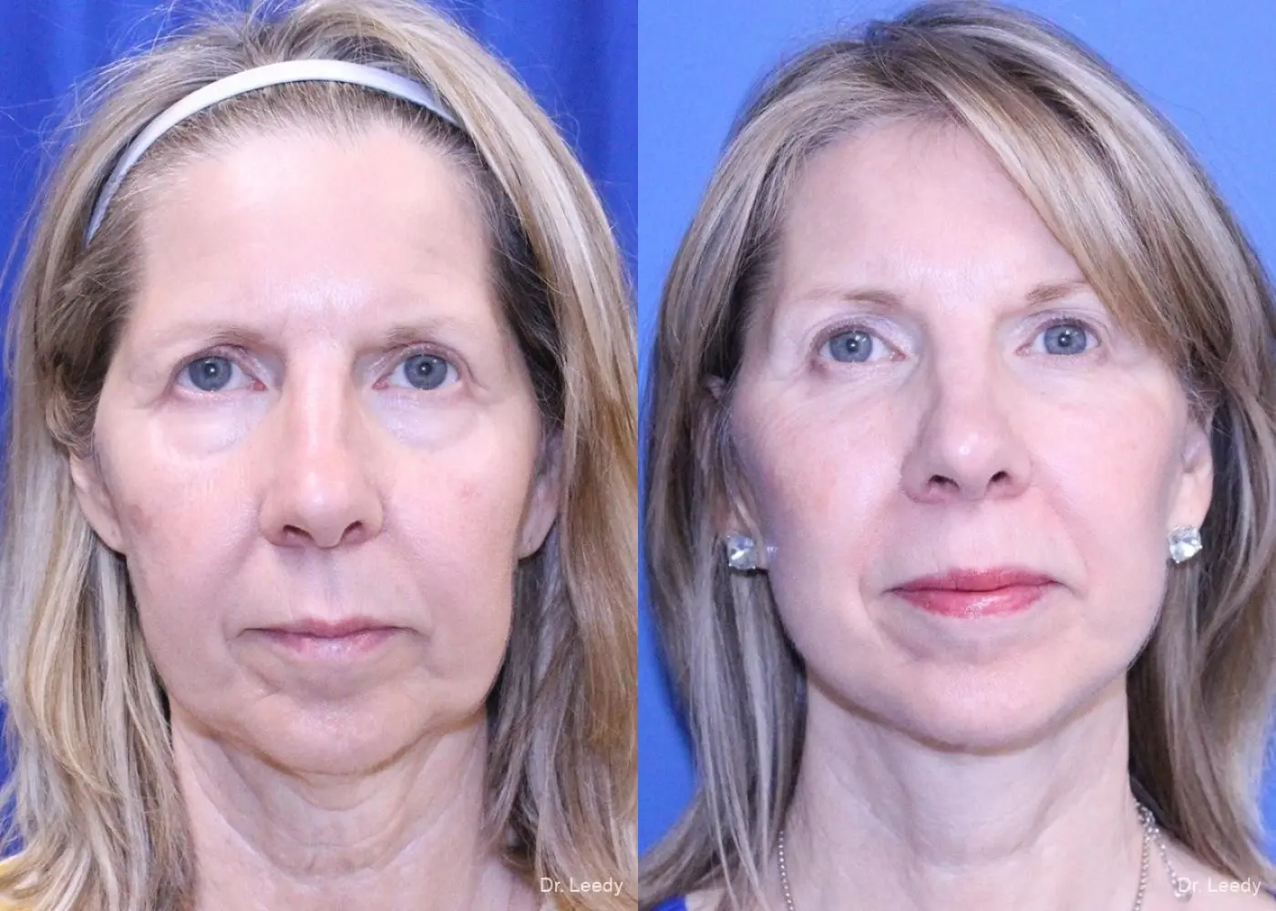 Brow Lift: Patient 4 - Before and After  