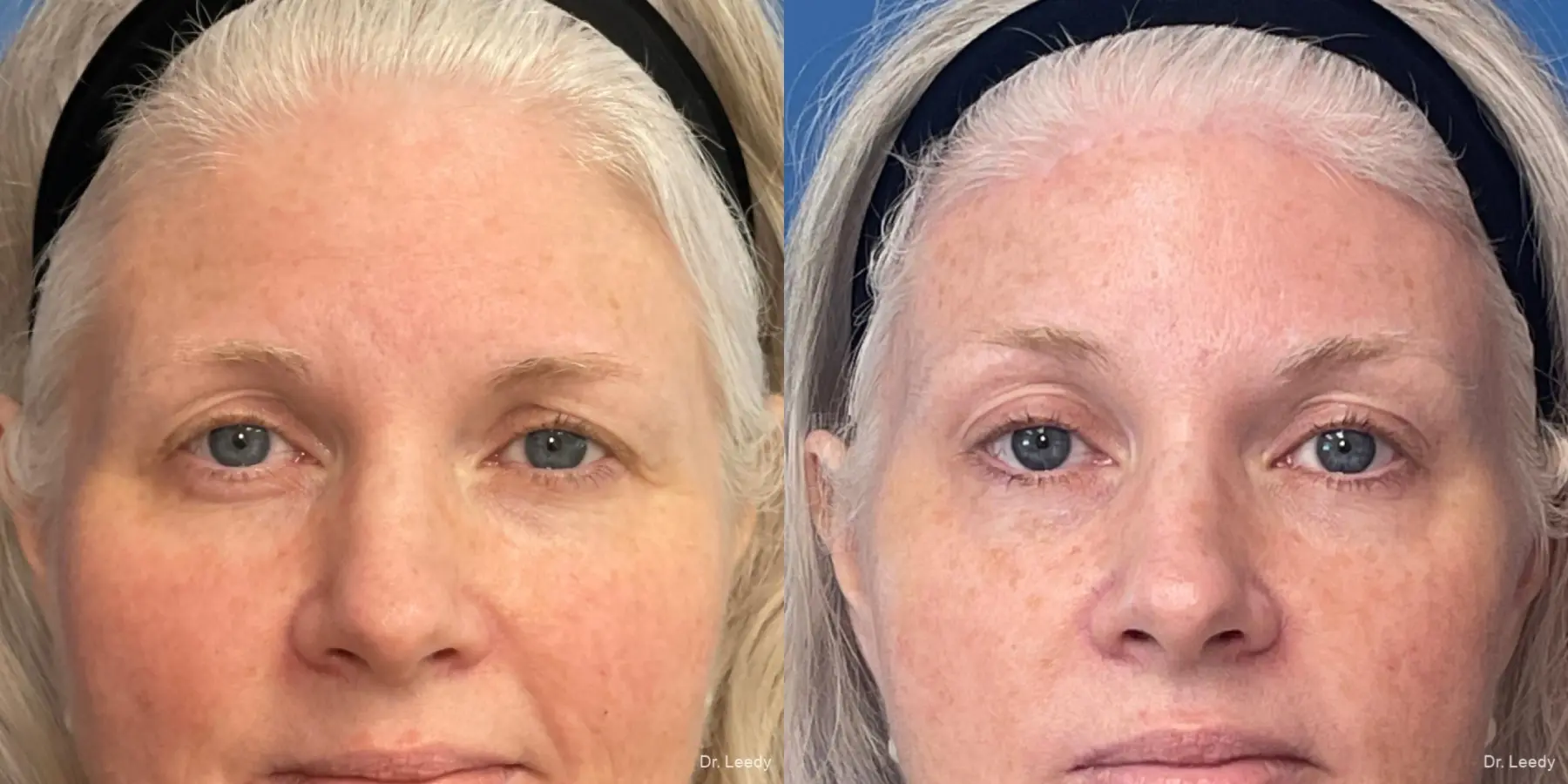 Brow Lift: Patient 5 - Before and After  