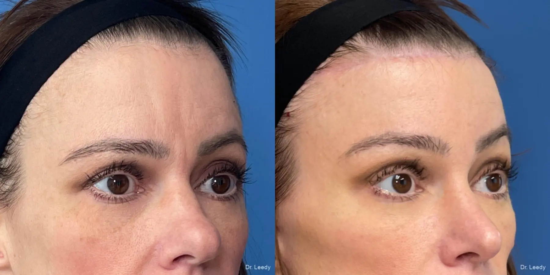 Brow Lift: Patient 1 - Before and After 1