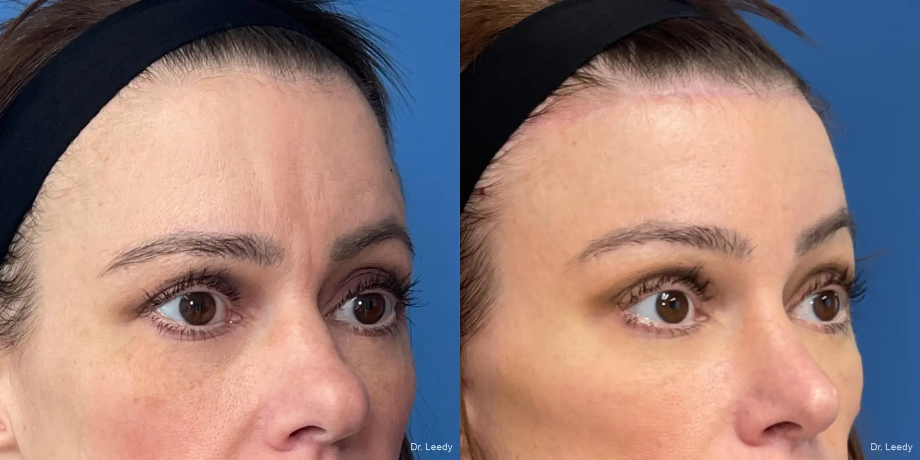 Brow Lift: Patient 1 - Before and After  