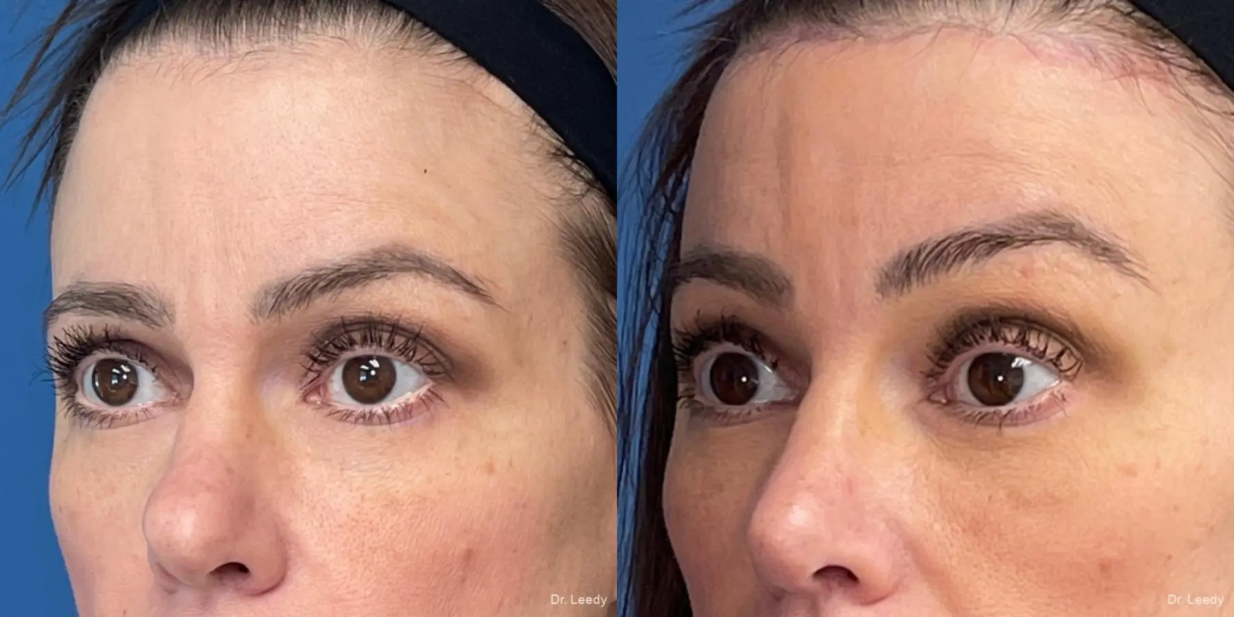 Brow Lift: Patient 1 - Before and After 3