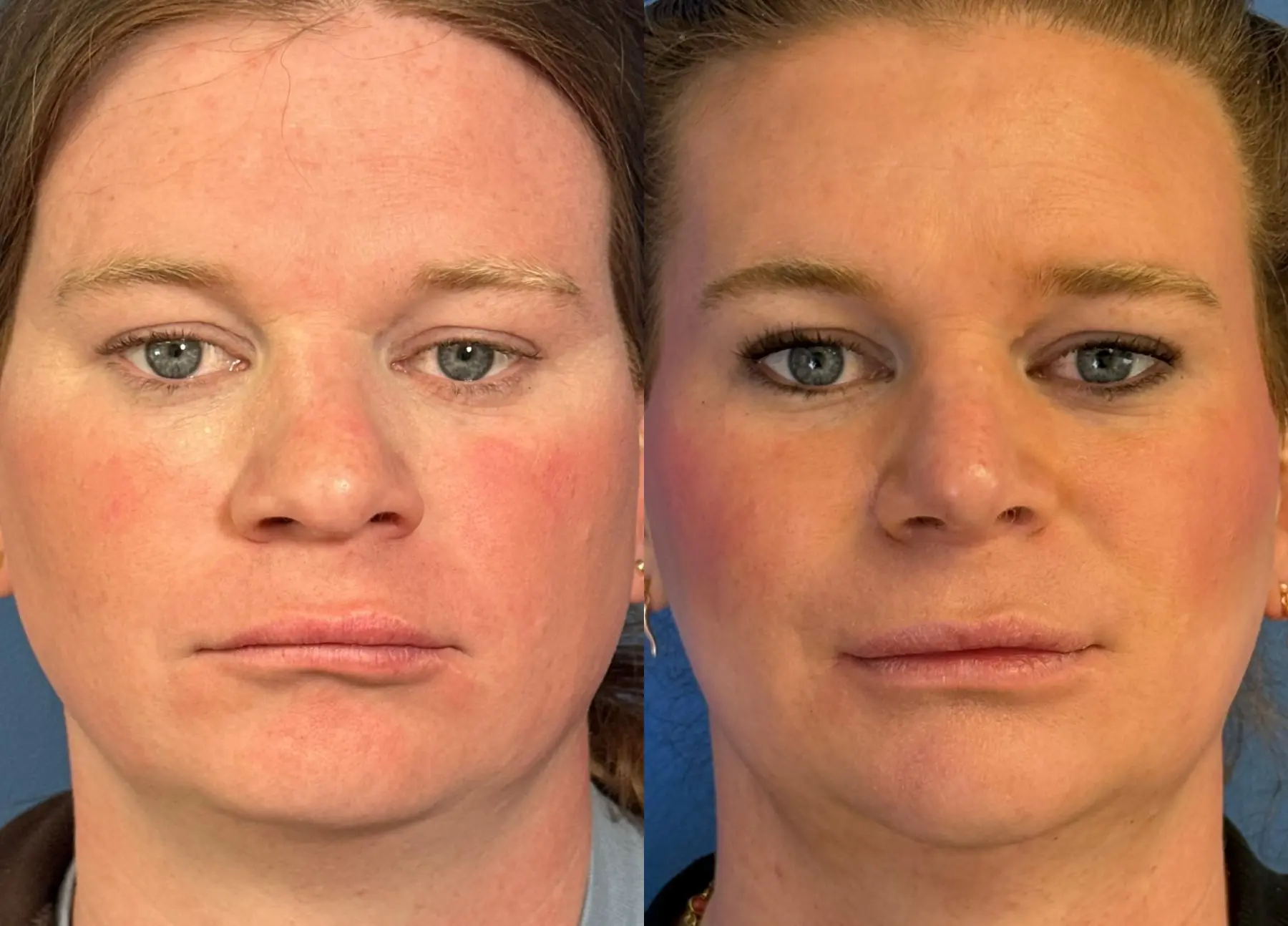 Chin Augmentation: Patient 2 - Before and After  