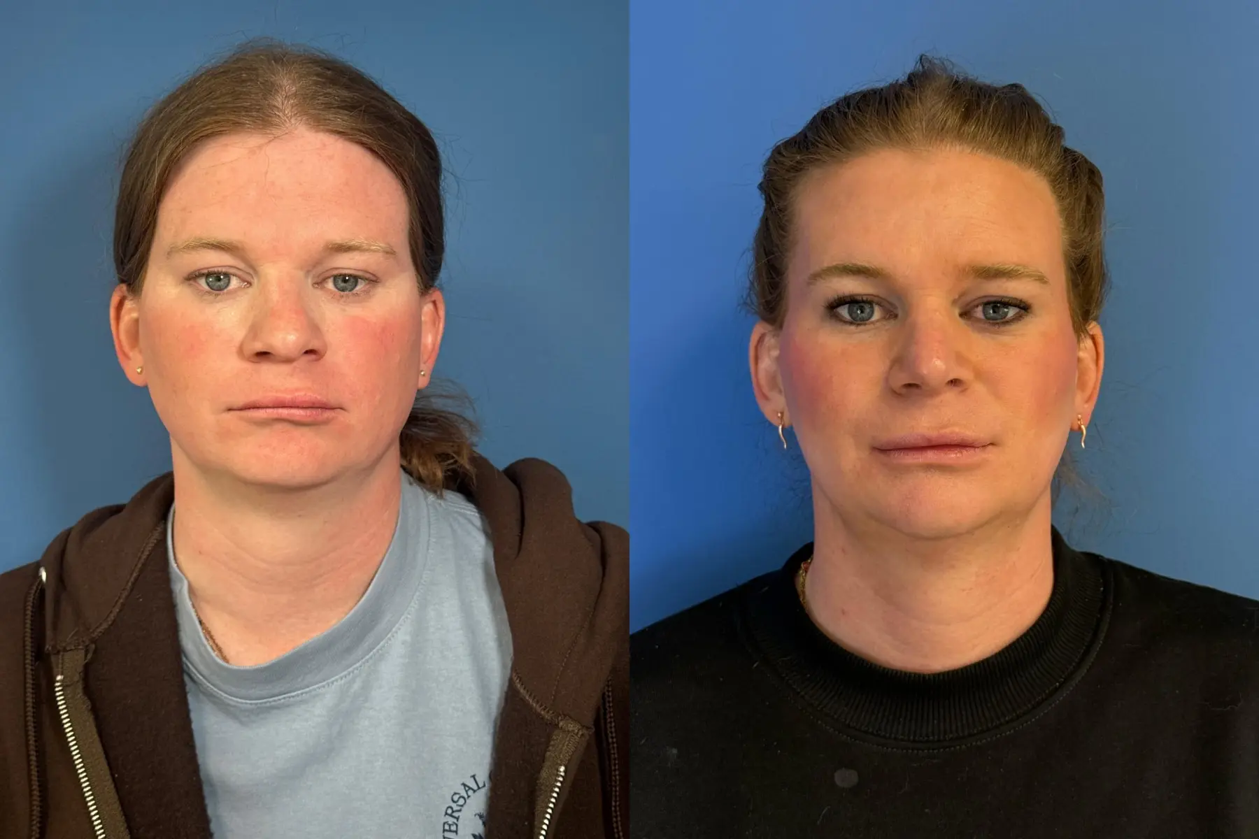 Chin Augmentation: Patient 3 - Before and After  