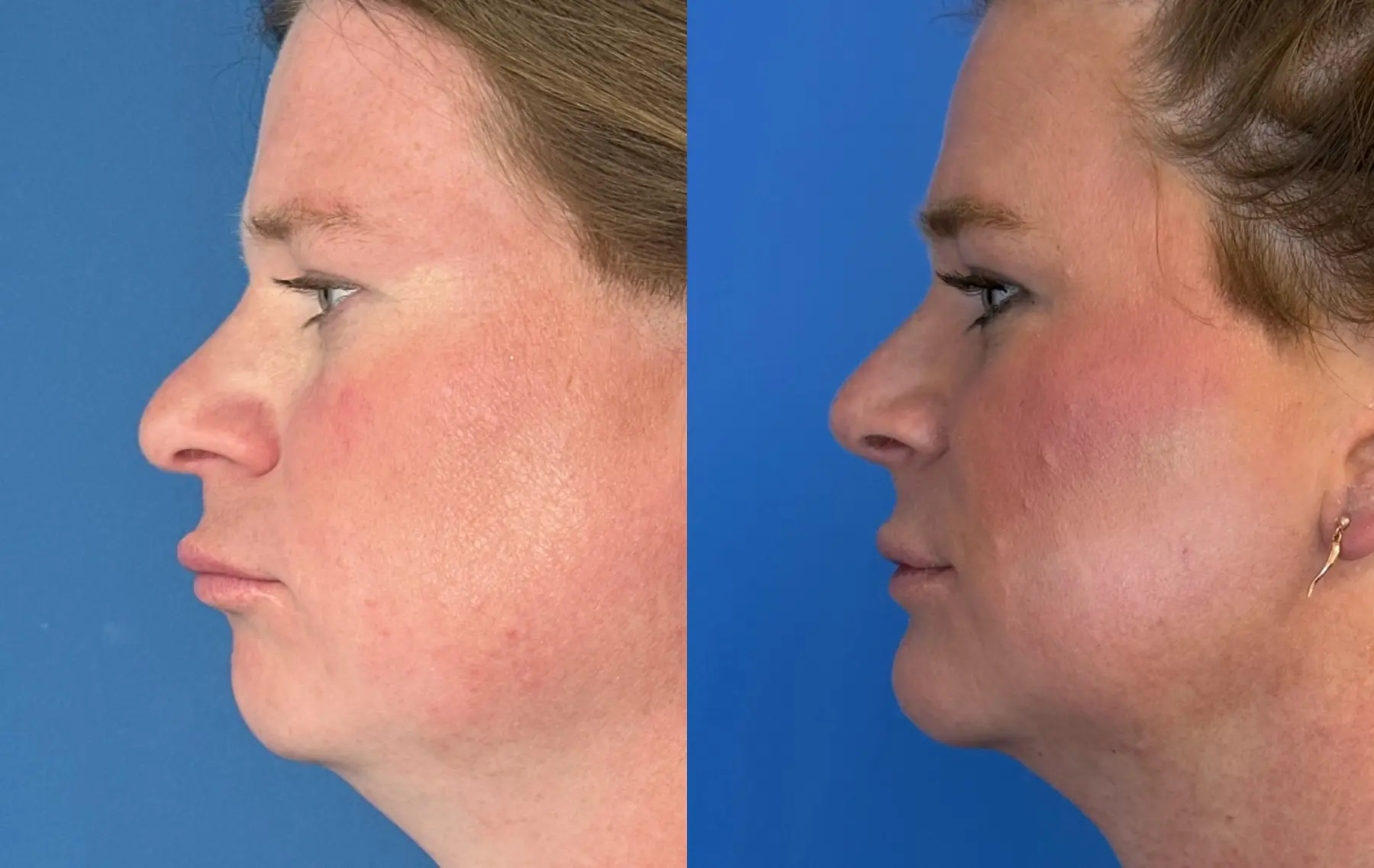 Chin Augmentation: Patient 2 - Before and After 3