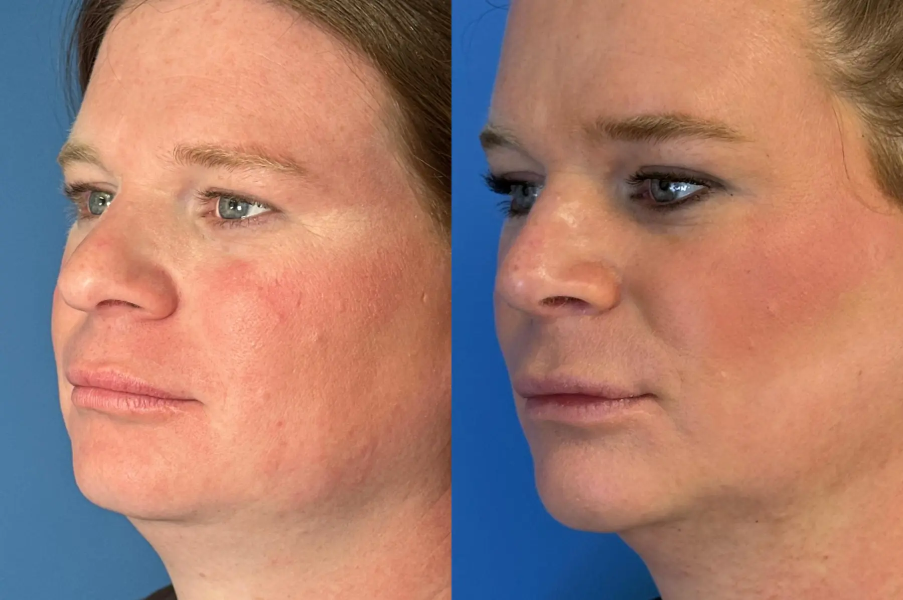 Chin Augmentation: Patient 2 - Before and After 2