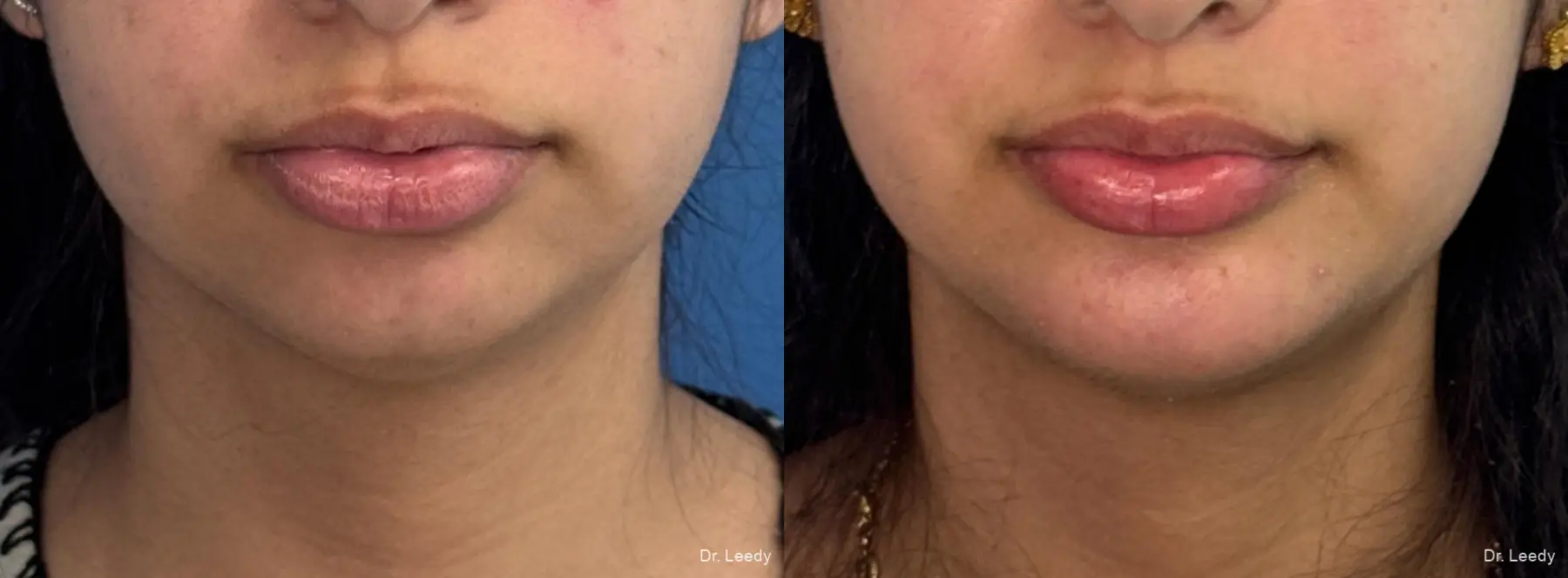 Chin Augmentation: Patient 2 - Before and After  
