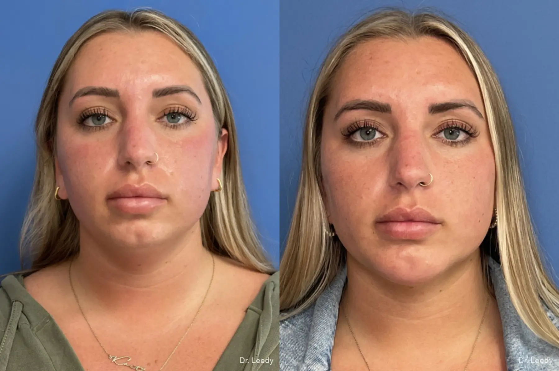 Chin Augmentation: Patient 1 - Before and After  