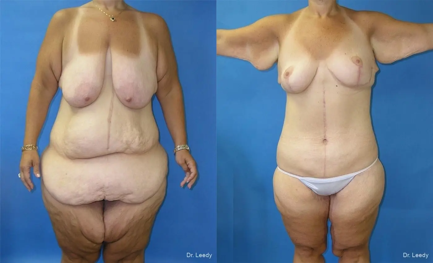 Circumferential Body Lift: Patient 1 - Before and After 1