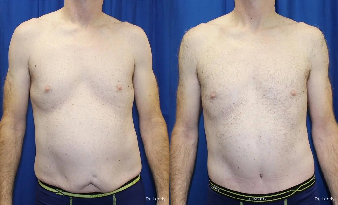 Circumferential Body Lift: Patient 2 - Before and After  