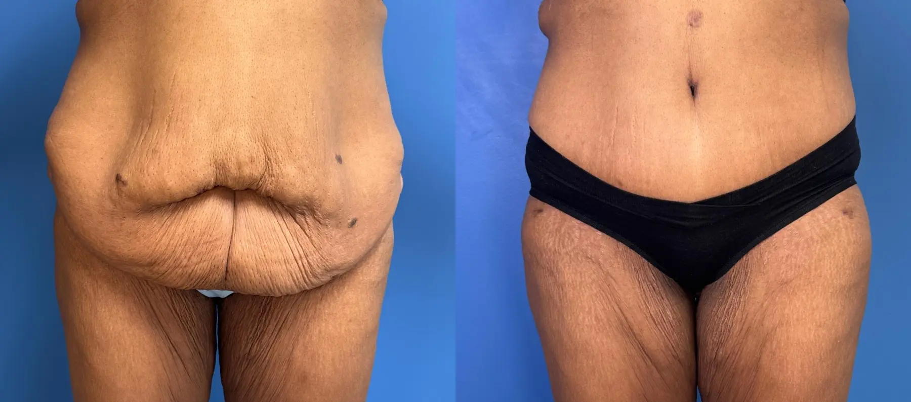 Circumferential Body Lift: Patient 6 - Before and After