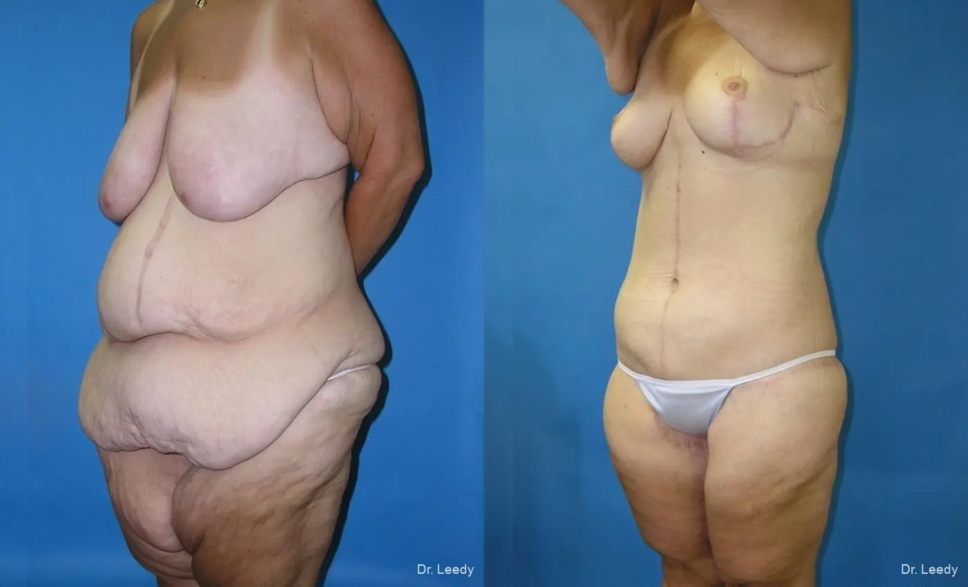 Circumferential Body Lift: Patient 1 - Before and After 4
