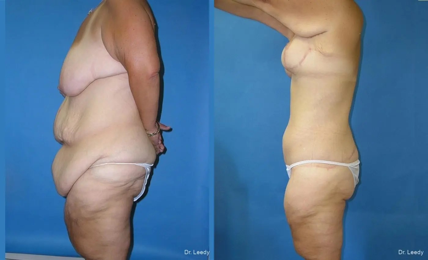 Circumferential Body Lift: Patient 1 - Before and After 5