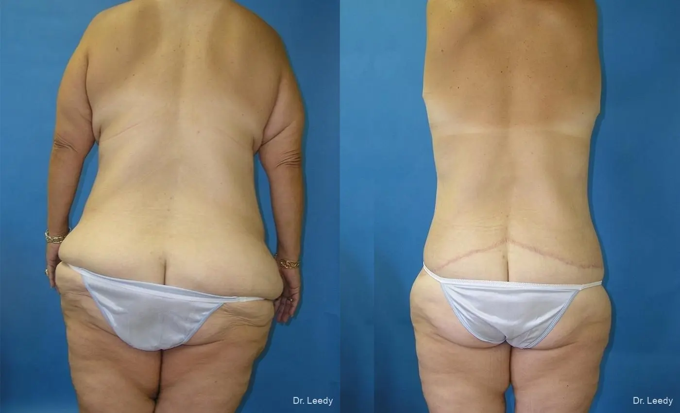 Circumferential Body Lift: Patient 1 - Before and After 6