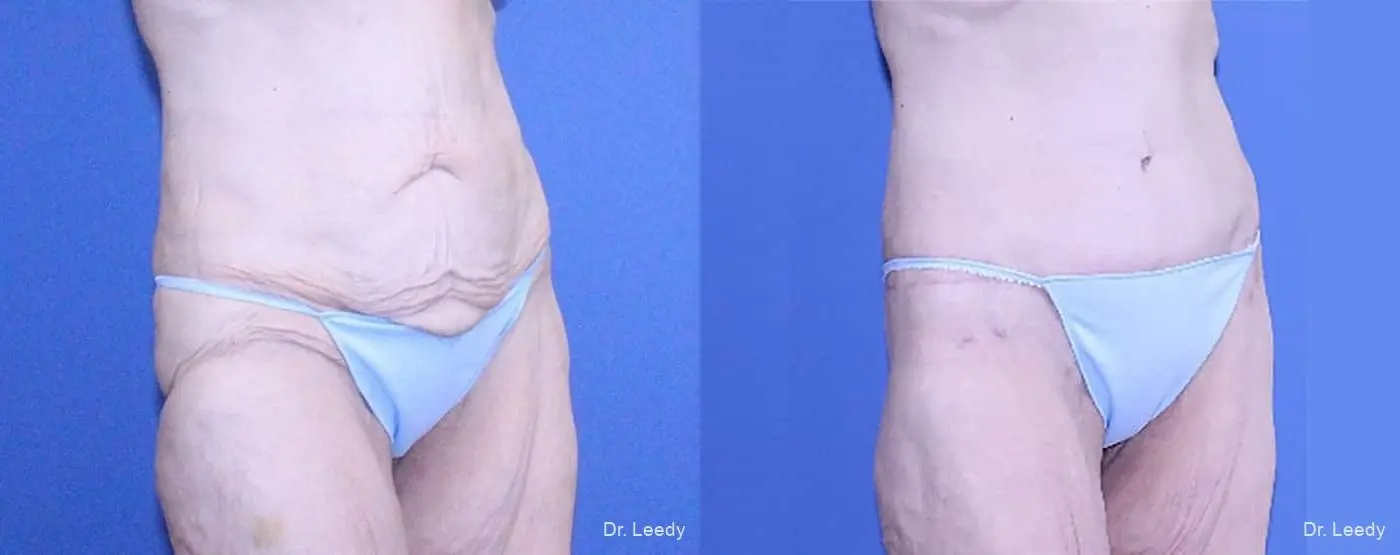 Circumferential Body Lift: Patient 3 - Before and After 2